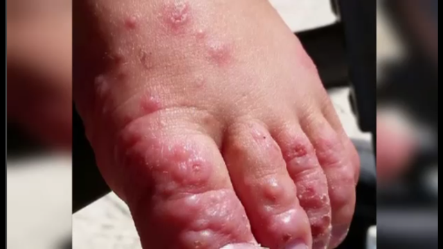 Hand, Foot And Mouth Outbreak In Grenada