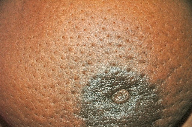 Seek Medical Attention Once You Observe Abnormality in or Around the Breasts