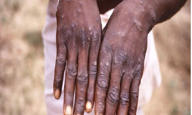 Ministry Of Health Press Release Re: No Cases of Monkeypox in The Federation Of St. Kitts & Nevis