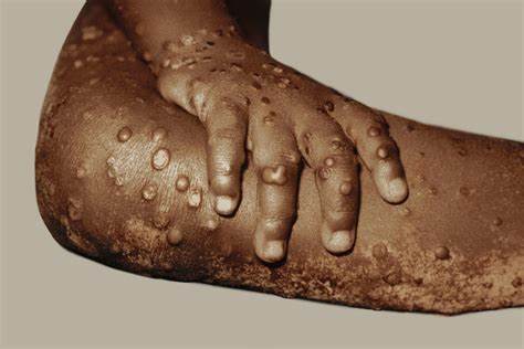 No Restrictions on Entry of Persons or Imported Goods from Any Country at This Time Due to Monkeypox