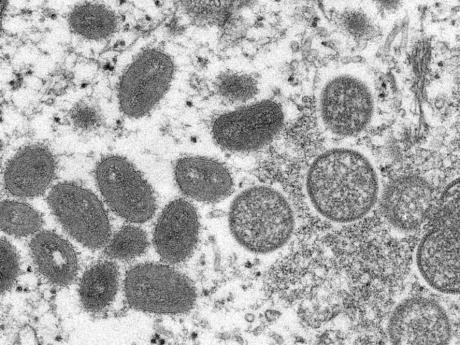 UK: Monkeypox cases rise to 1,735 with most cases in London