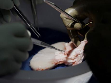 Pig Kidney Works in A Donated Human Body for Over a Month