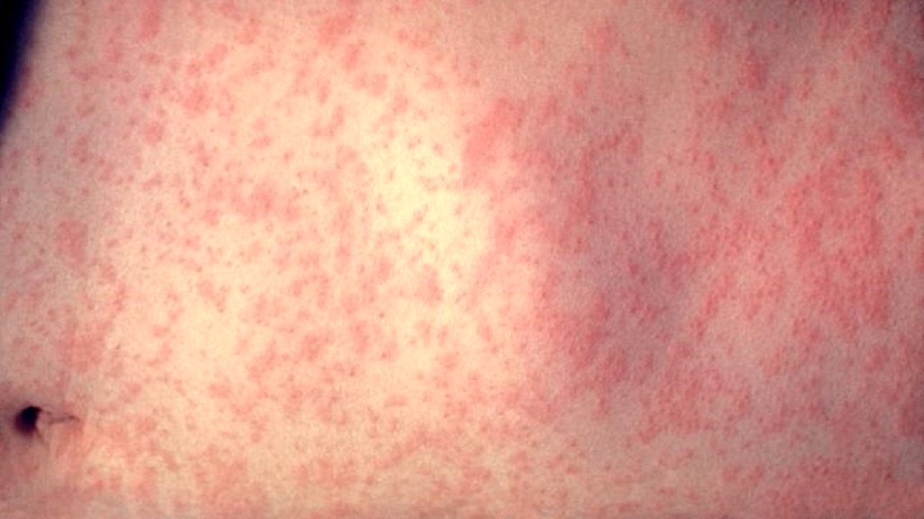 St Kitts And Nevis Concerned Over Imported Cases of Measles