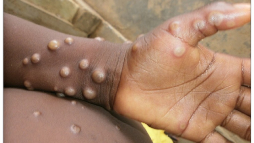 Antigua Steps Up Port  Surveillance Amid Mpox Threat