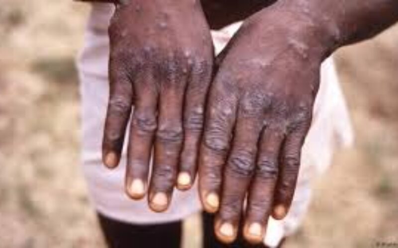UWI Pledges to Dedicate Research and Expertise to Fight Mpox
