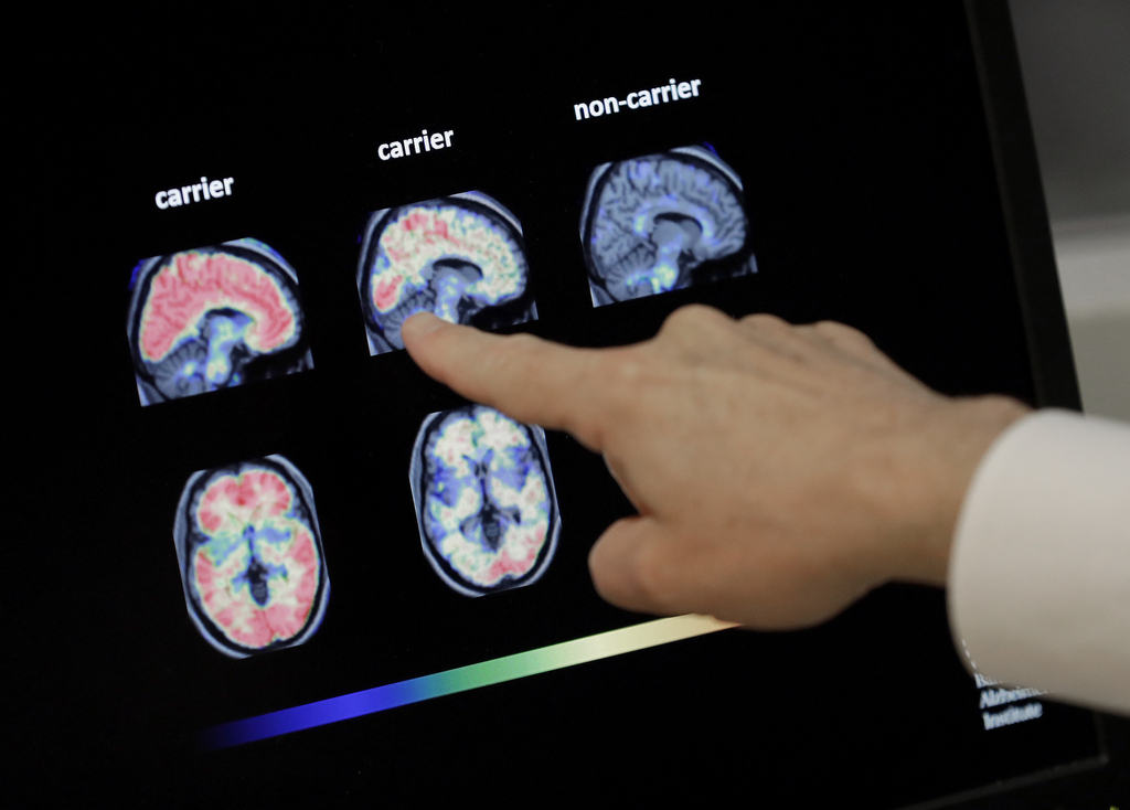 Living Longer Can Mean More Dementia but There Are Ways to Reduce Risk